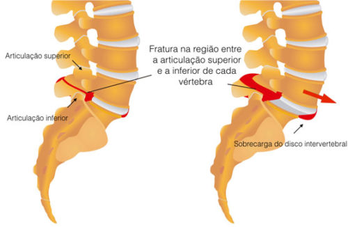 Espondil Lise Espondilolistese Dr Bruno Fontes